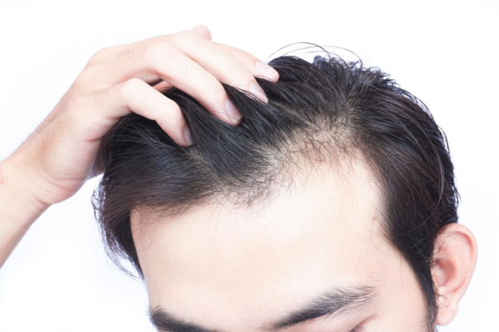 Cara Mengobati Penyebab Umum Kerontokan Rambut Pria